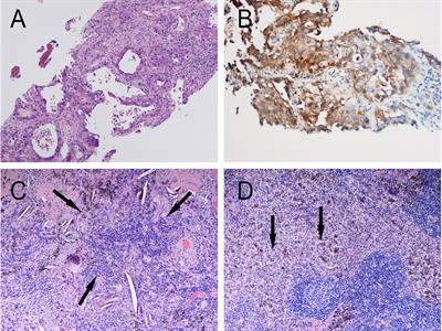 Neoadjuvant Programmed Cell Death Protein 1 Blockade Combined With Stereotactic Body Radiation Therapy for Stage III(N2) Non-Small Cell Lung Cancer: A Case Series